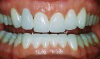 porcelain veneers and crowns after