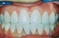 porcelain veneers after