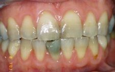 porcelain veneers before