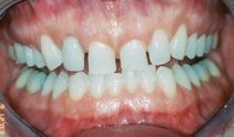 porcelain veneers and crowns before