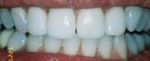 porcelain crowns after