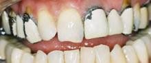 porcelain crowns before