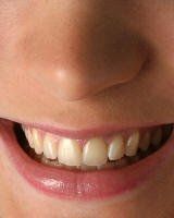 Teeth whitening before