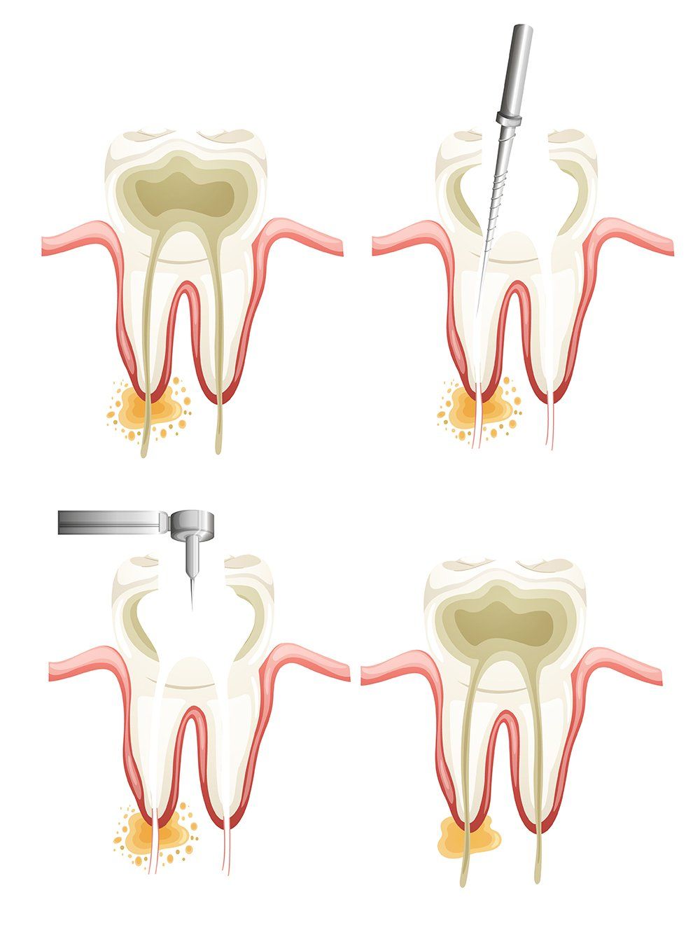 Root Canal Treatment