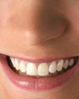 Teeth whitening after