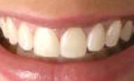 Teeth whitening after