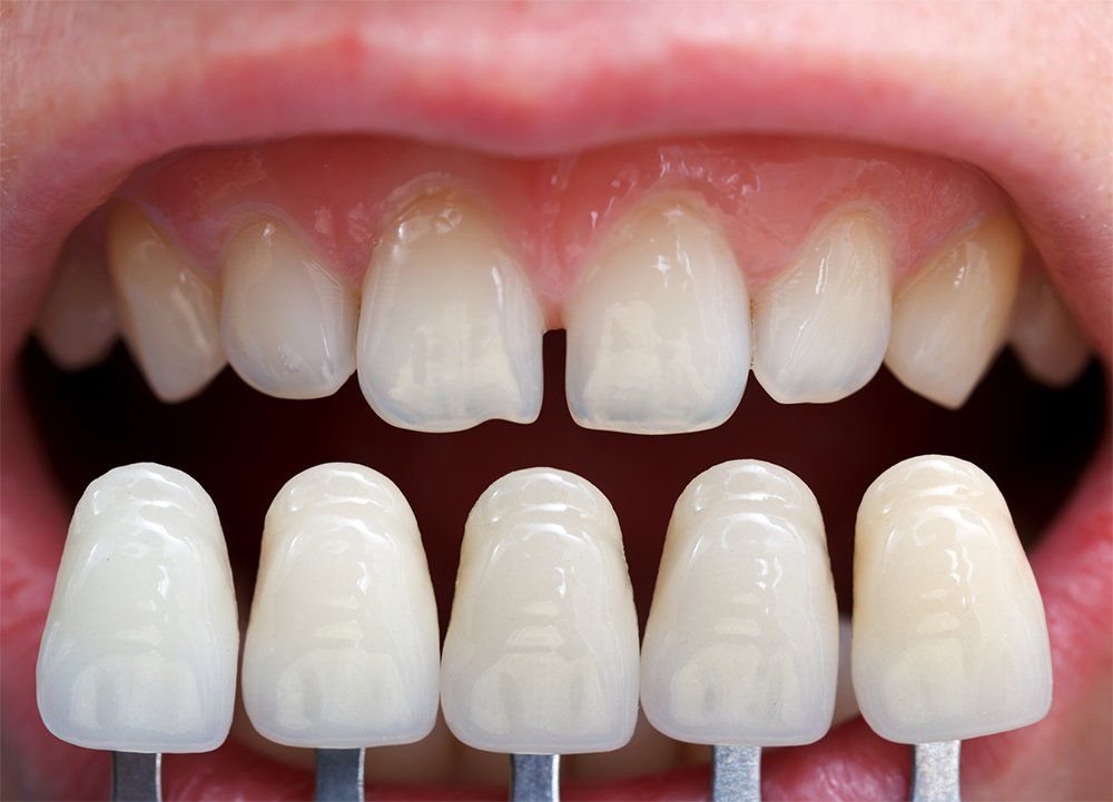 Veneers 1